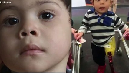 Parents Ask Thief Who Stole Toddler's $10,000 Prosthetic Leg To Give It Back