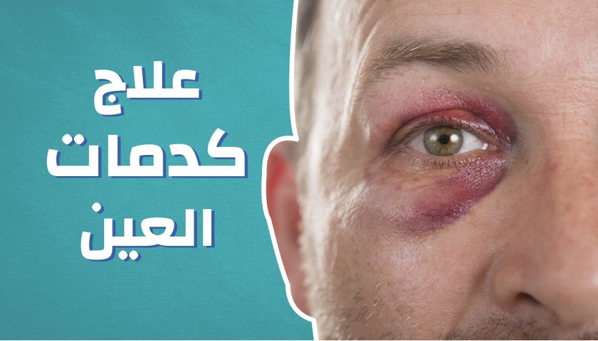علاج كدمات العين - فيديو Dailymotion