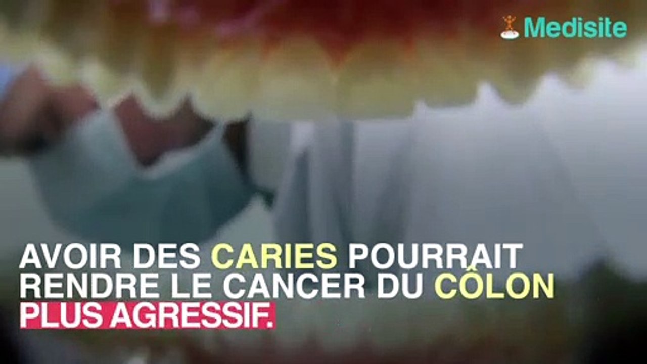 La bactérie à l'origine des caries responsable de cancers du côlon agressifs