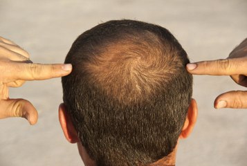 Wie kann man eine Glatze verhindern?