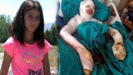 Bitlenen saçlarını benzinle yıkamak isterken kendini yaktı