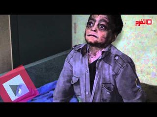 محمد يعاني من مرض حوله إلى "مسخ" وينتظر تدخل السيسي لإنقاذه