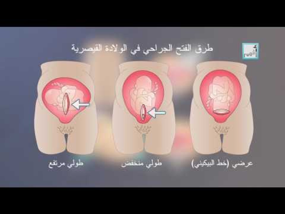 Alyaa Gad - C-Section الولادة القيصرية