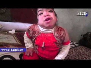 «مرض نادر» يهدد حياة «هاجر» وشقيقتيها بالدقهلية.. والأسرة تناشد السيسي بالتدخل