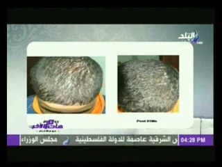 الدكتورة أغادير الجمال تكشف عن علاج جديد لمرض الصدفية بالمواد الطبيعية