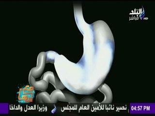 كل ما تريد أن تعرفه عن عملية "  تكميم المعدة - تدبيس المعدة "
