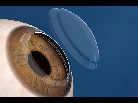 صدى البلد | لهذه الأسباب لا توجد قوائم انتظار لعمليات زراعة القرنية في الهند