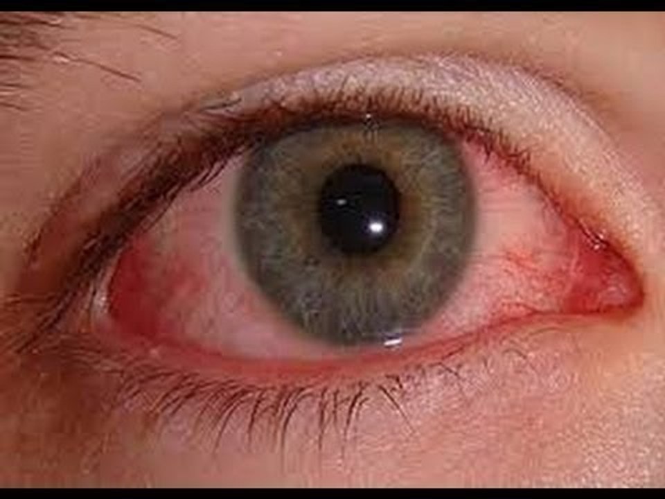 صدى البلد |  طبيب عيون يكشف العلاج الأمثل لمرضى حساسية العين