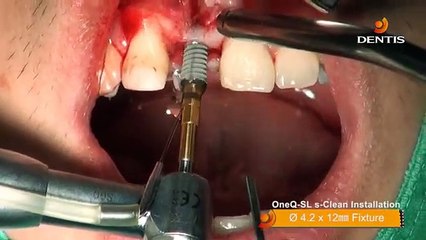 ایمپلنت دندان در کلینیک تاج 🦷