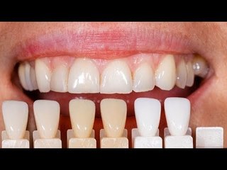 صدى البلد | تعرف على 3 حالات لا يمكنها إجراء «الهوليود سمايل»