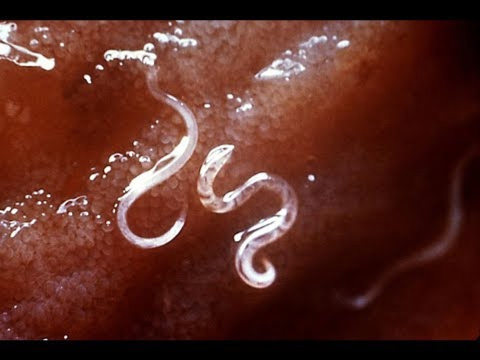 صدى البلد | النقيب: استئصال دودة اسطوانية من داخل مريضة بالمنظار