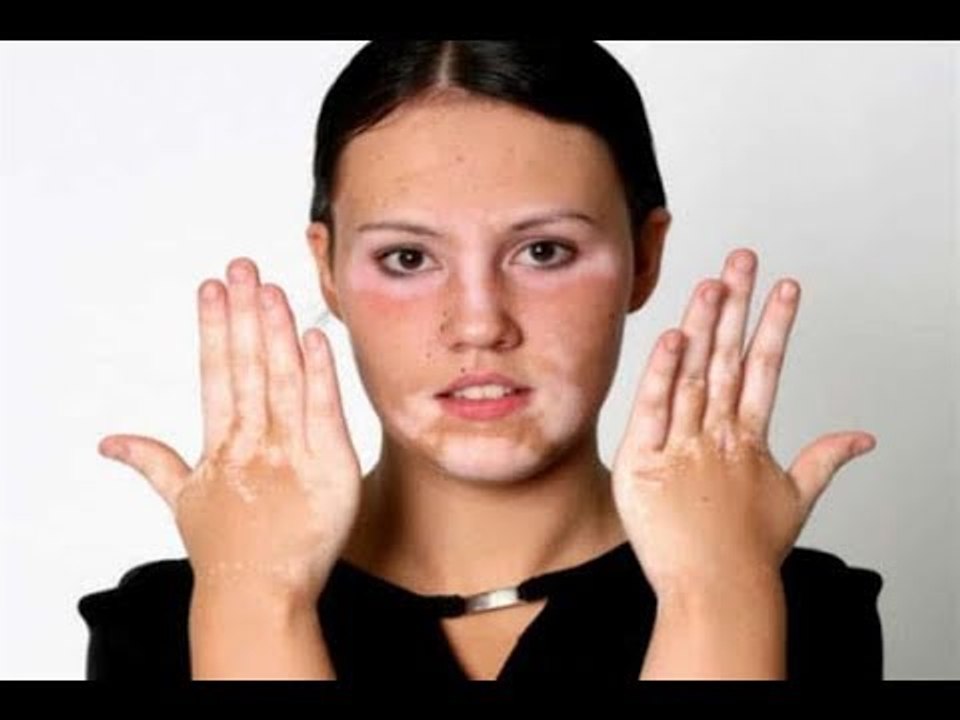 صدى البلد | دكتور جلدية تكشف السبب الرئيسي للإصابة بمرض البهاق