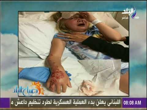 صباح البلد - شاهد الجحيم الذي سببته الحِنة المصرية السامة مع طفلة بريطانية