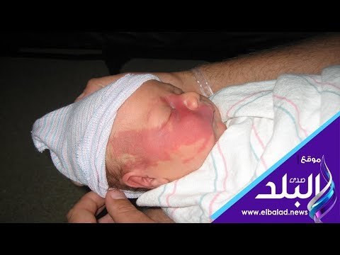 صدي البلد | طرق علاج الوحمات الدموية الداخلية والخارجية