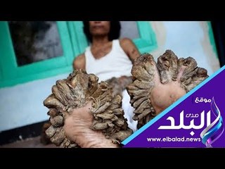 صدي البلد | متلازمة الرجل الصخري أحد أغرب الأمراض .. إليك أعراضه