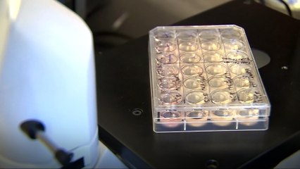 Patients and researchers optimistic about second H.I.V. cure using stem-cell transplant