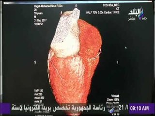 صباح البلد - إفتتاح المرحلة الأولى بمركز القلب بجامعة الأزهر