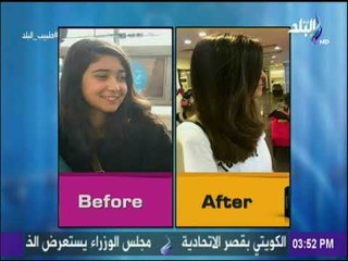 تقصف الشعر وطرق علاجه بالبلاسنتا - د.منه زاهر | طبيب البلد