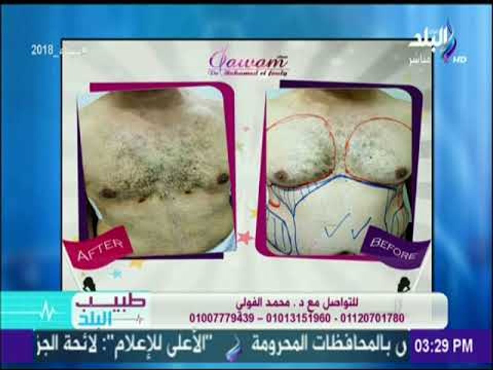كيف تتخلص من الدهون العنيدة؟ - د.محمد الفولي | طبيب البلد
