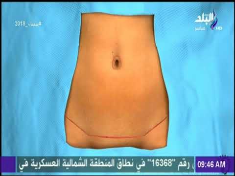 صباح البلد - عملية شفط دهون البطن - الفوائد والمخاطر مع د.أشرف سمعان