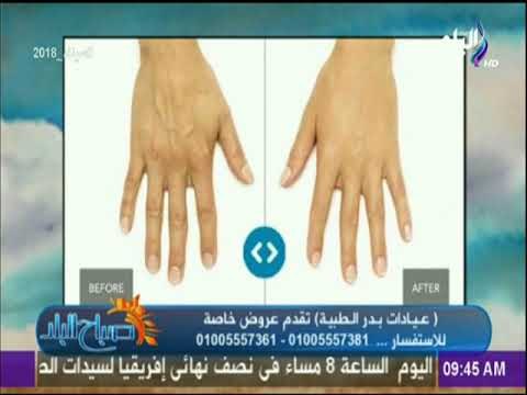 صباح البلد - تعرف علي كل ما هو جديد في شفط الدهون الموضعية مع الدكتور أشرف سمعان