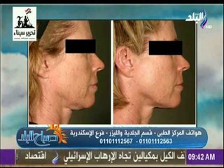 صباح البلد - تعرف على تقنية «الهايفو» لشد الوجه والجلد دون جراحة