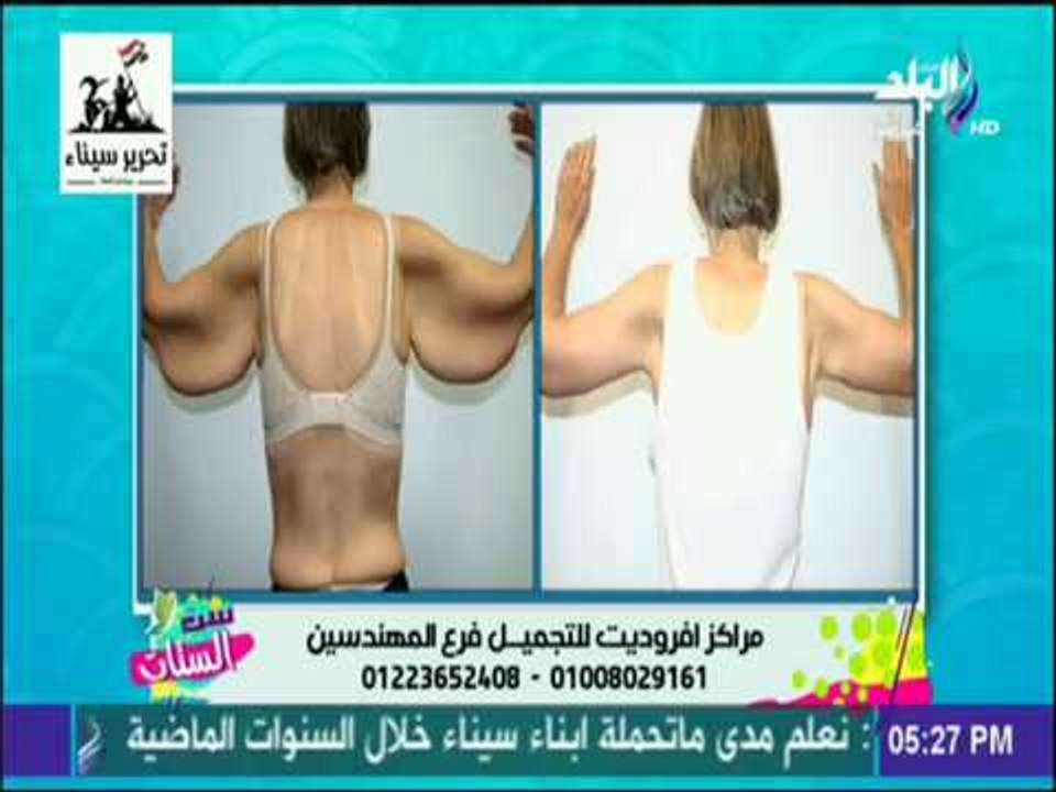 ست الستات - عملية شفط الدهون وشد البطن - د. أشرف كامل