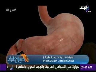 عملية تكميم المعده - د. أحمد صلاح | صباح البلد