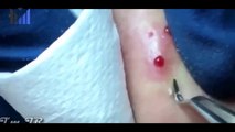 SATISFYING PIMPLE CYST BLACKHEAD POPPING 2019