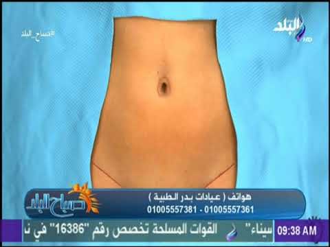 صباح البلد - الجديد فى عمليات شفط الدهون ونحت القوام مع الدكتور أحمد صلاح