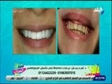 ست الستات -  أهم طرق تجميل الأسنان - د. امجد رسلان