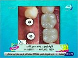ست الستات - كيف تتم زراعة الأسنان - د. باسم سمير