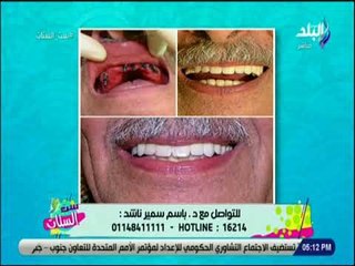 ست الستات - تقنية جديدة لزراعة الأسنان خلال دقائق - د.باسم سمير