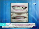 طريقة مبسطة لشرح كيفية زراعة الاسنان - د. اسراء احمد