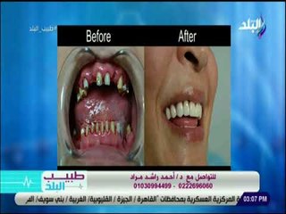 طبيب البلد - ودع مشاكل سنانك واستمتع بابتسامة هوليود - د. أحمد مراد