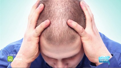 #صباح_الخير_يا_عرب| الحل النهائي للصلع وتساقط الشعر عن طريق الـ PRP