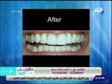 طبيب البلد - د. احمد مراد يكشف أحدث تقنيات تبيض الأسنان