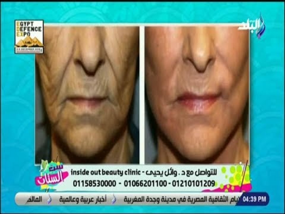 ست الستات - أحدث طرق لشد الجلد المترهل بدون جرا...