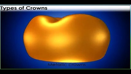 Dental Crowns and Bridges | Tooth Cap Price in Pune | Clinic Near FC Road, Mukund Nagar