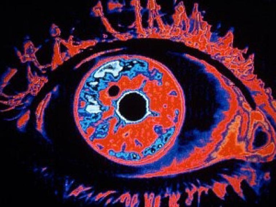 Día Mundial del Glaucoma