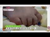 무지외반증 예방하는 ‘발가락 수건 접기 운동’ [닥터 스마일] 7회 20170815