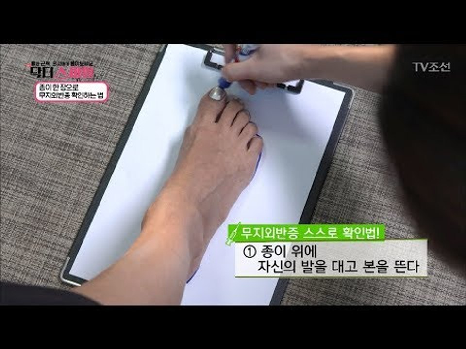 무지외반증, 집에서 확인하는 방법! [닥터 스마일] 7회 20170815