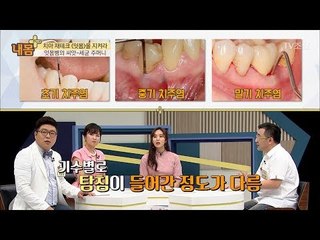 잇몸병의 씨앗! ‘세균 주머니’ [내 몸 플러스] 68회 20170806