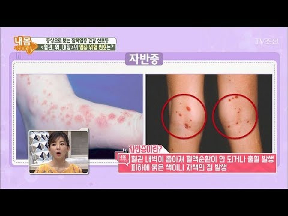 전신에 염증 발생! ‘잠복염증’의 심각한 증상들! [내 몸 사용설명서] 166회 20...