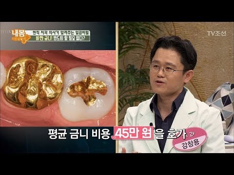 비싼 금니! 반드시 할 필요 없다! [내 몸 사용설명서] 173회 20171007