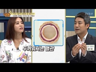 고혈압-고지혈증, 뇌졸중 걸리기 쉽다?! [내 몸 플러스] 77회 20171022