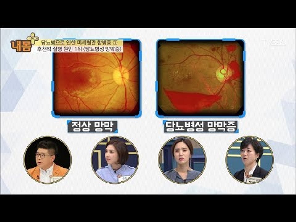 당뇨병으로 인한 실명 ‘당뇨병성 망막증’ [내 몸 플러스] 79회 20171112