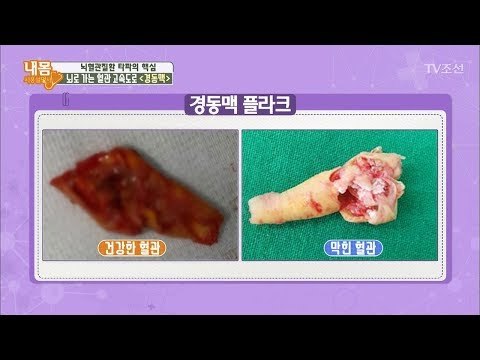 혈관에 쌓인 지방 덩어리 ‘플라크’ 뇌와 심장을 노린다! [내 몸 사용설명서] 177회 20171103