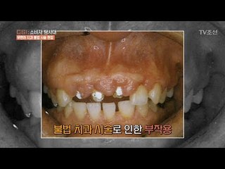 불법 치과 시술로 인한 끔찍한 부작용 [CSI 소비자 탐사대 6회] 20180107