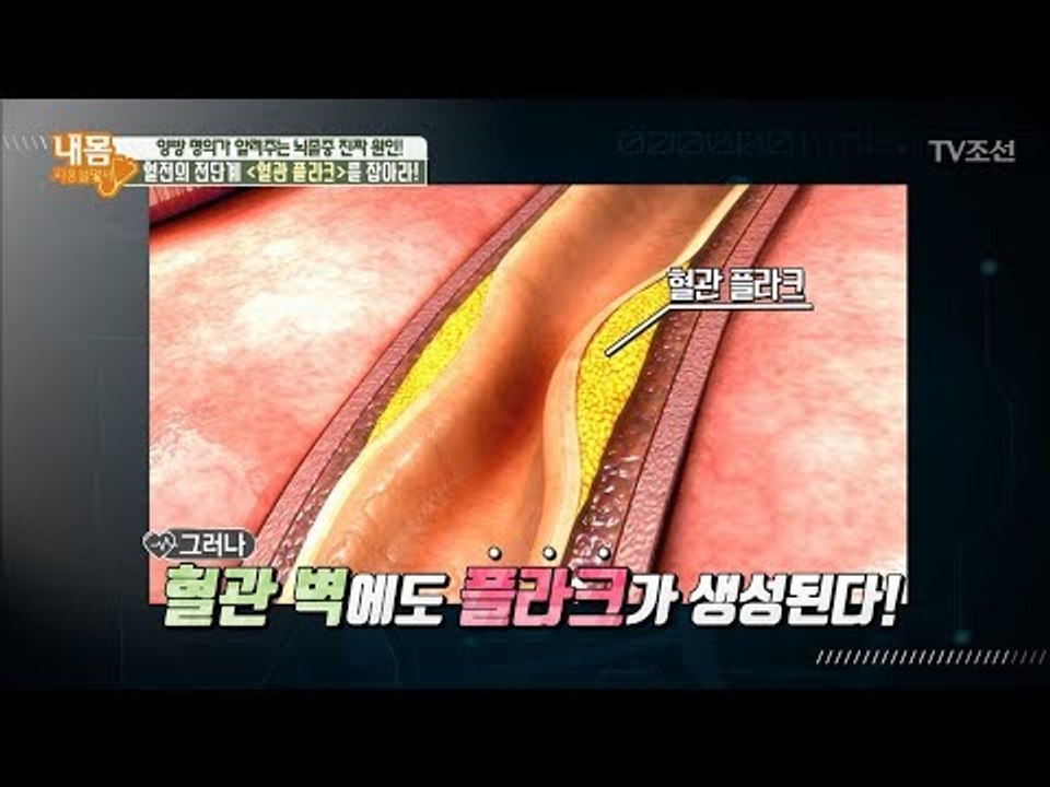 뇌졸중의 강력한 원인 ‘혈관 플라크’ [내 몸 사용설명서] 193회 20180223